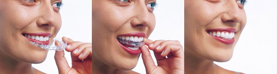 invisalign-demo