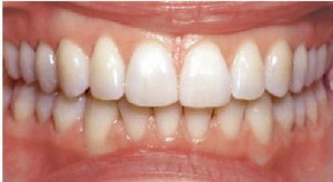 After Invisalign