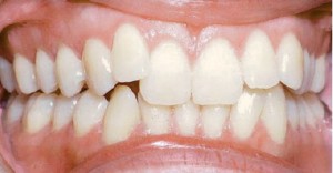 Before Invisalign