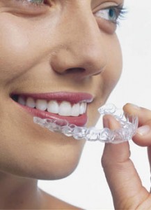 invisalign-invisible-braces