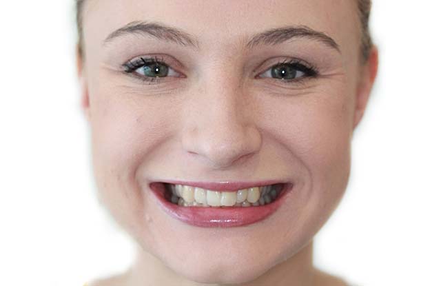 Before Invisalign