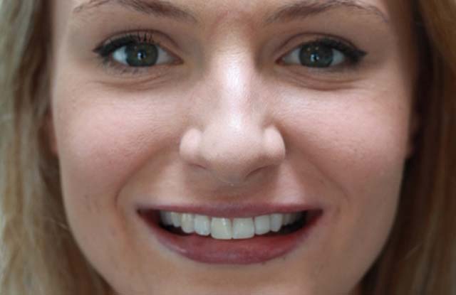 After Invisalign