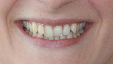 Emma before