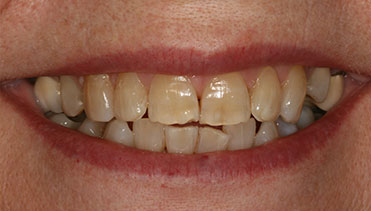 Tessa Way Before Photo